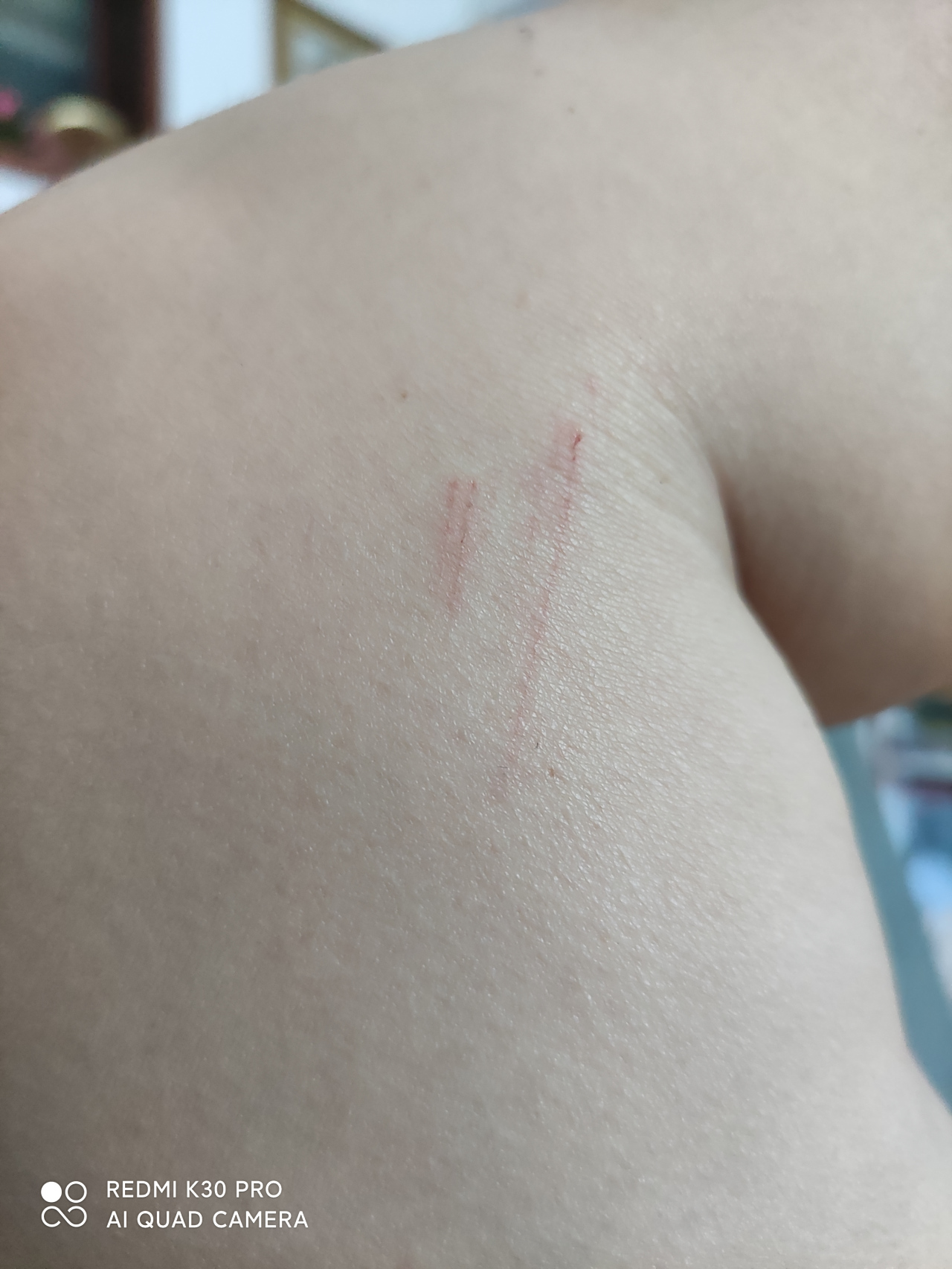 这是狗爪抓的伤痕吗?