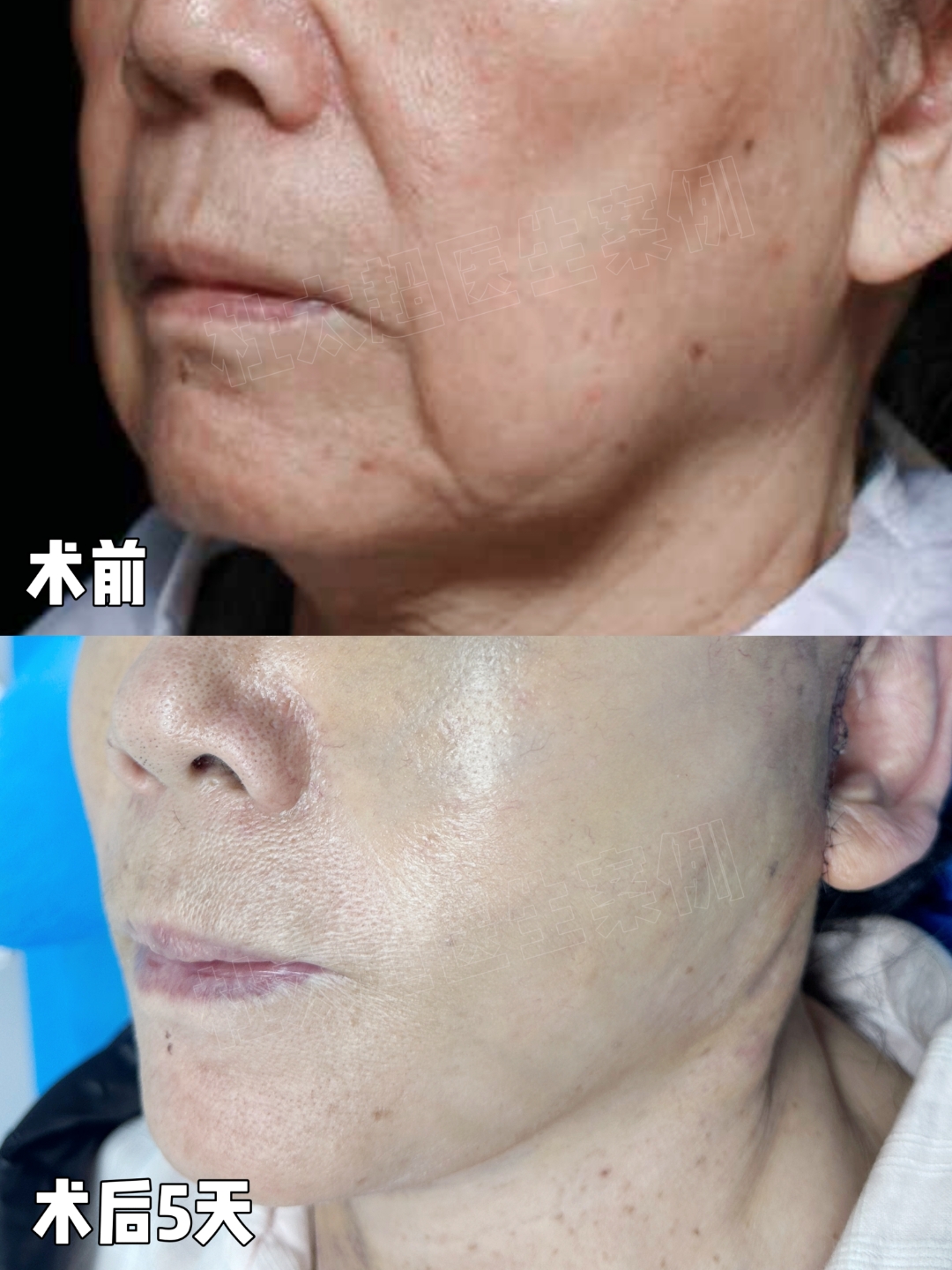 71岁求美者 拉皮术后5天实拍对比 年轻一代人的感觉 真正的奶奶变