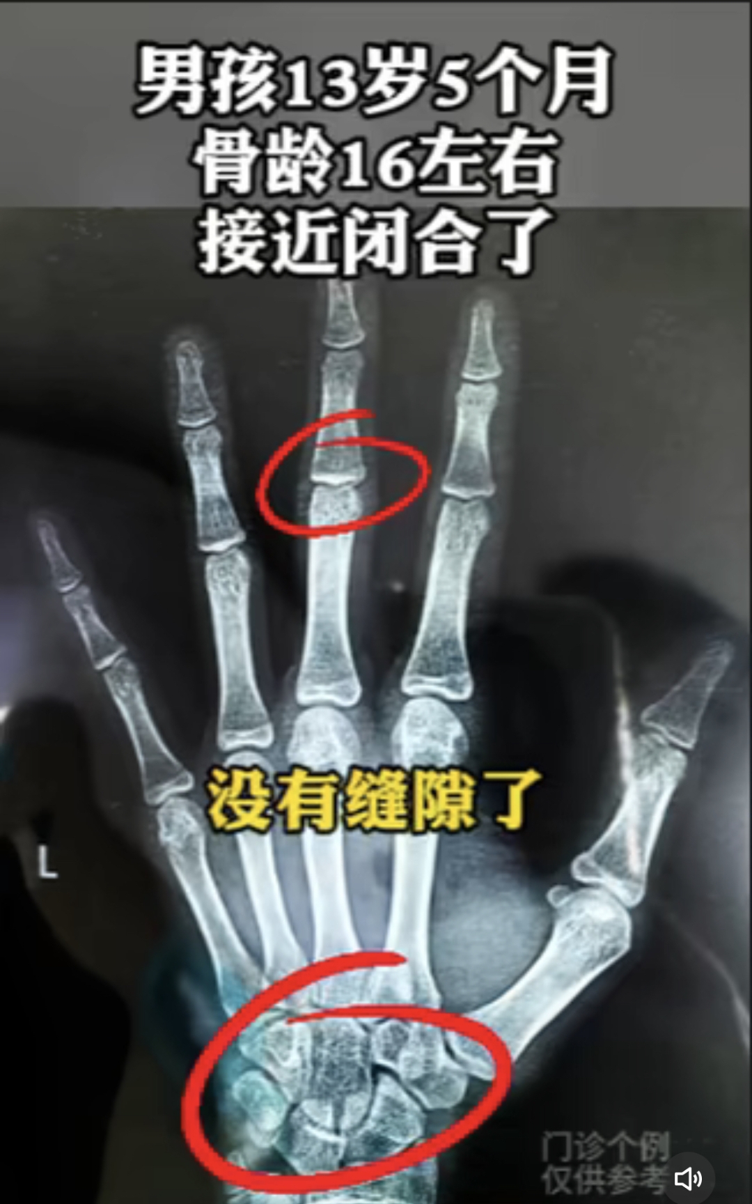 13岁男孩骨龄接近闭合不再长了身高定型168cm