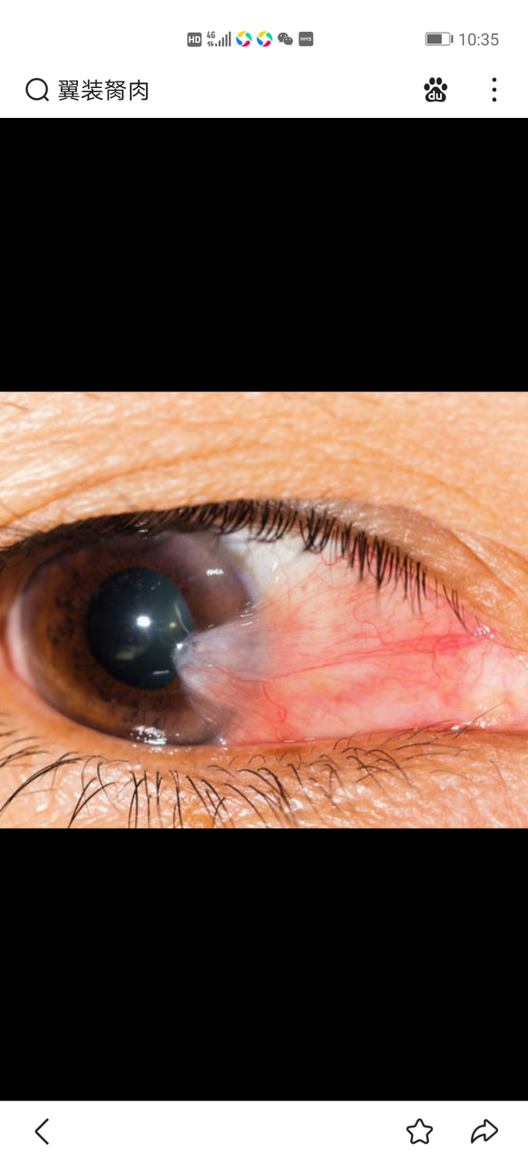 所有人 眼睛长翼装胬肉最好不要手术,手术后的复