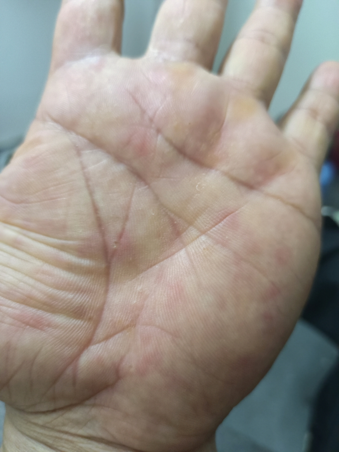 手掌有暗红点痒,是怎么会事?
