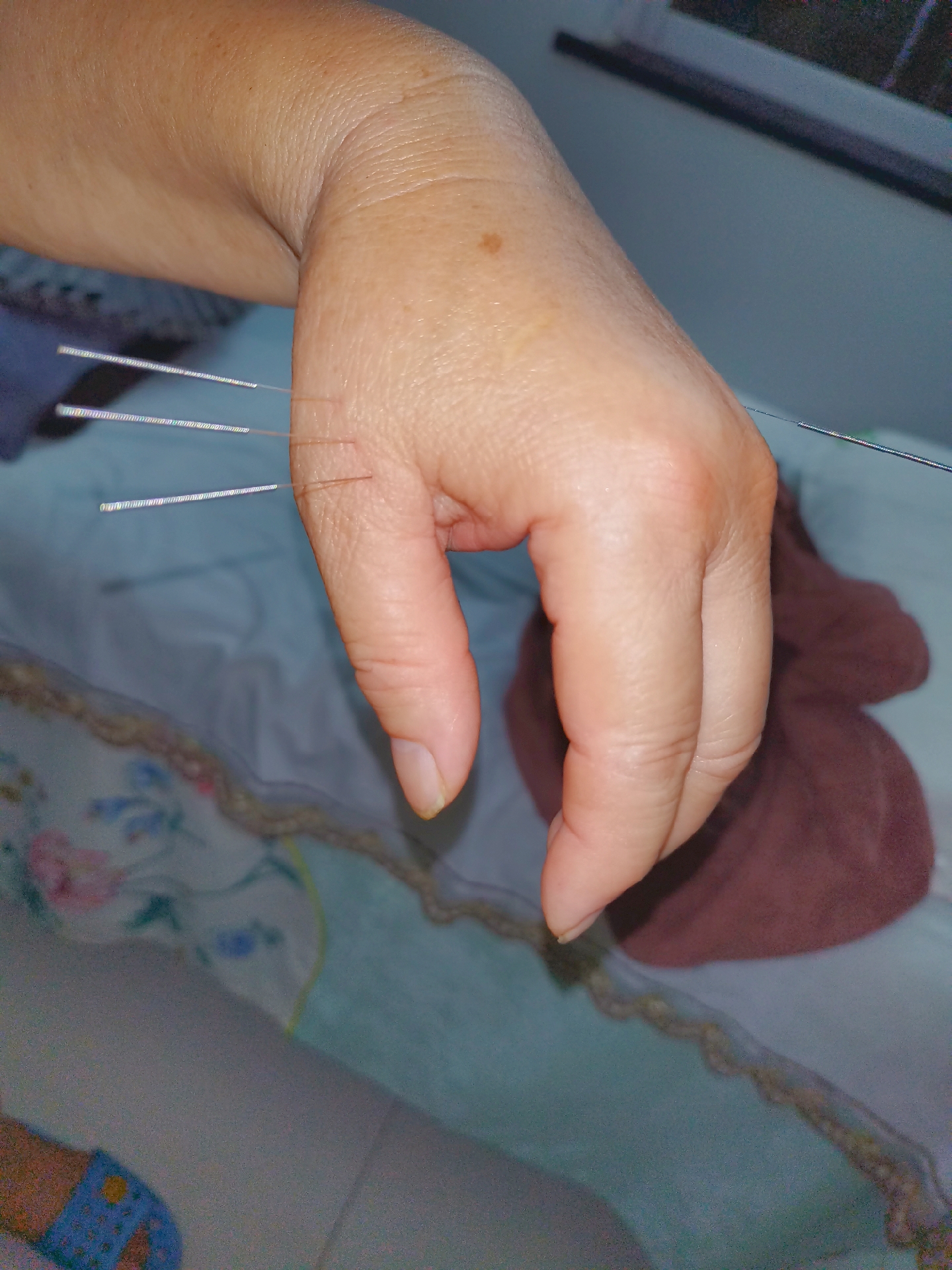 肩膀疼痛,手不能后背,董针三肩穴