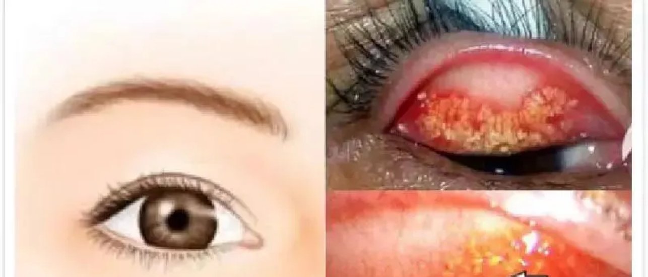 但可不是啥好事儿她去检查视力,医生在眼皮上翻出十几颗小疙瘩,这东西