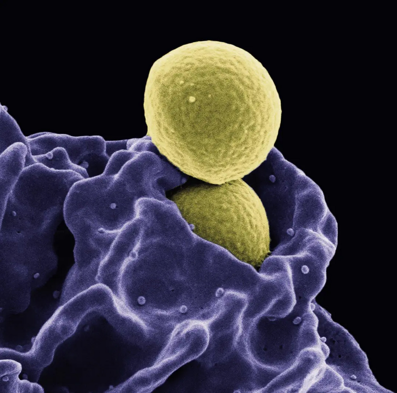 电子显微镜下,白细胞正在吞噬黄色葡萄球菌