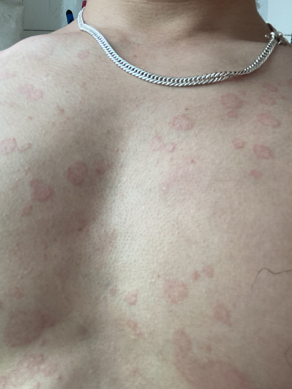 皮肤上起这种不痛不痒的红斑 有时候会消失,有时候我就可以起