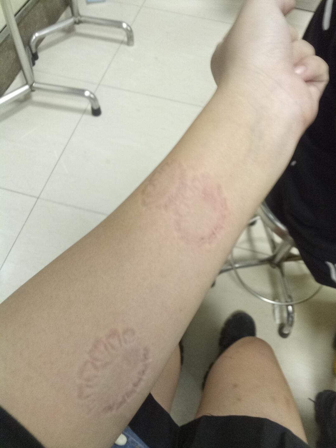 我的手臂被女朋友咬成这个样子,真的疼的我不要不要的.