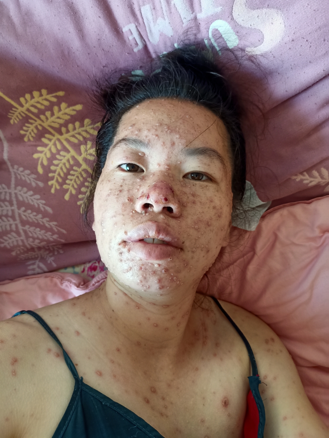 水痘第五天全身没那么痒了但是鼻子上的被我搞坏了,是这样的,医生说破