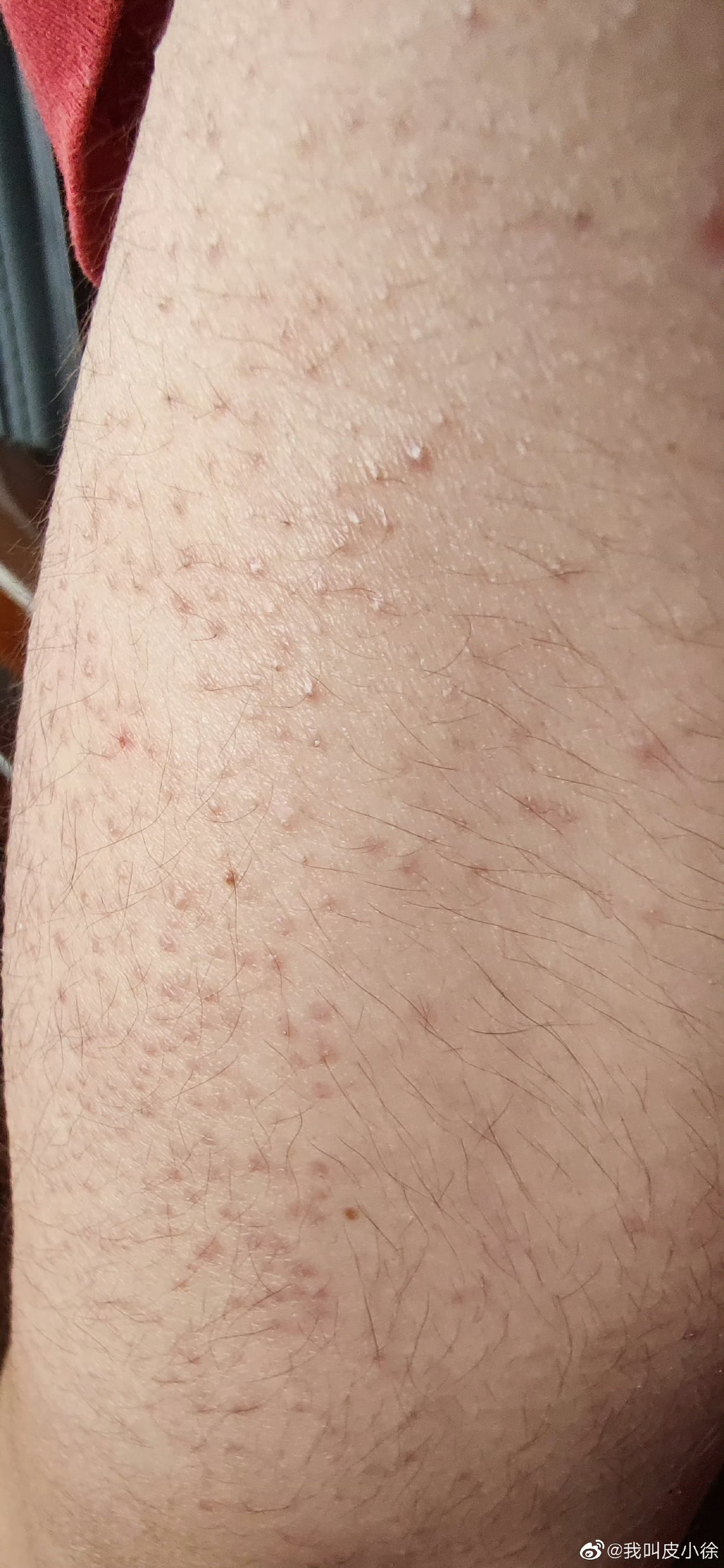 鸡皮肤的人特别多,严重程度也不一样,有的只在两个胳膊上,有的大腿 