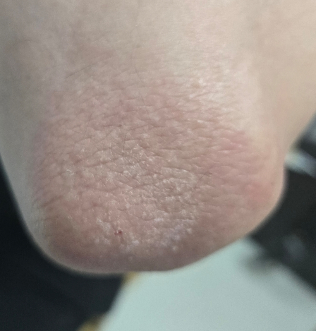 一般我们就是外用激素类药膏治疗,每天一~二次