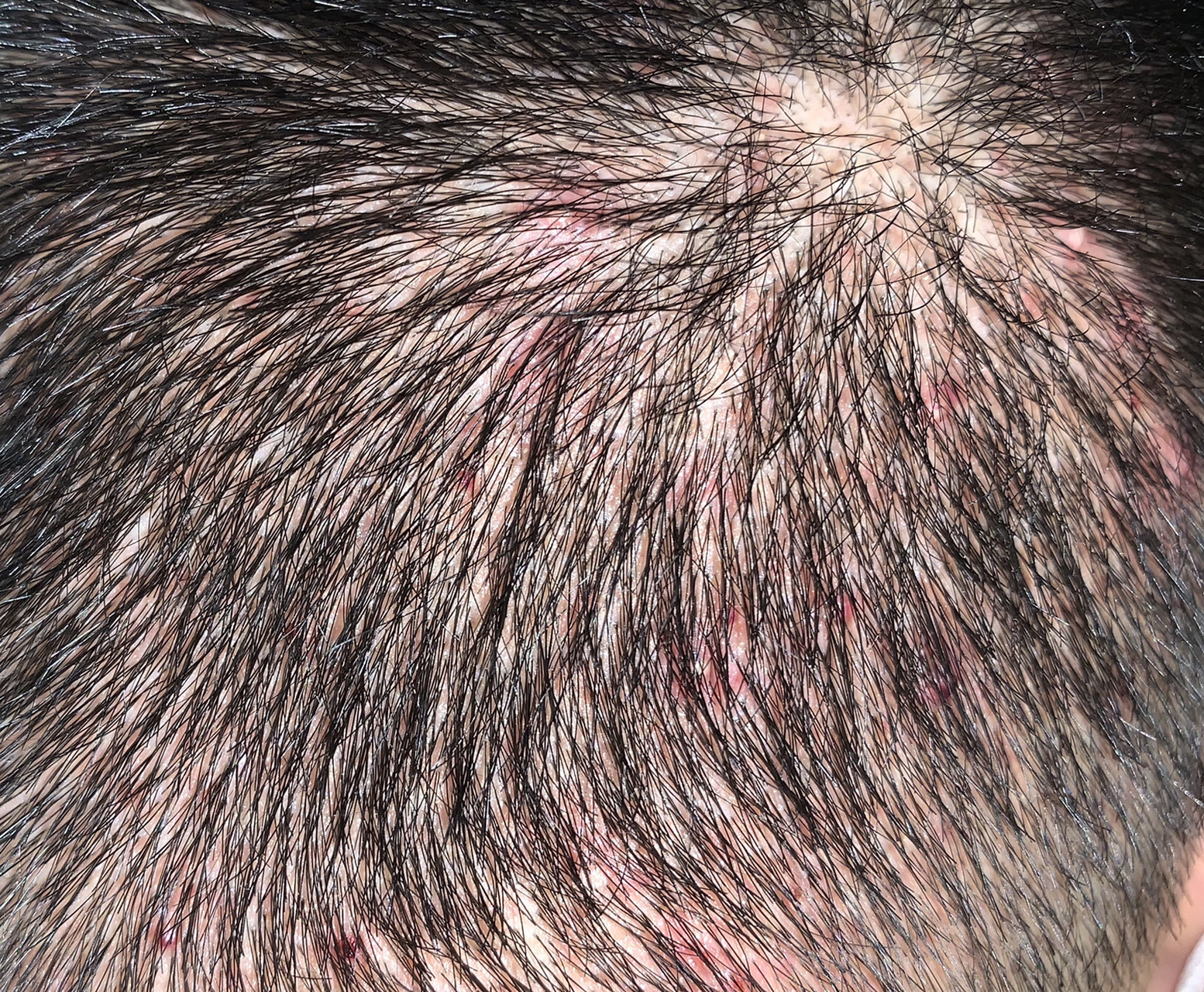 植发后头枕部,也就是毛发移植取材的部位,容易出现合并症:毛囊炎.