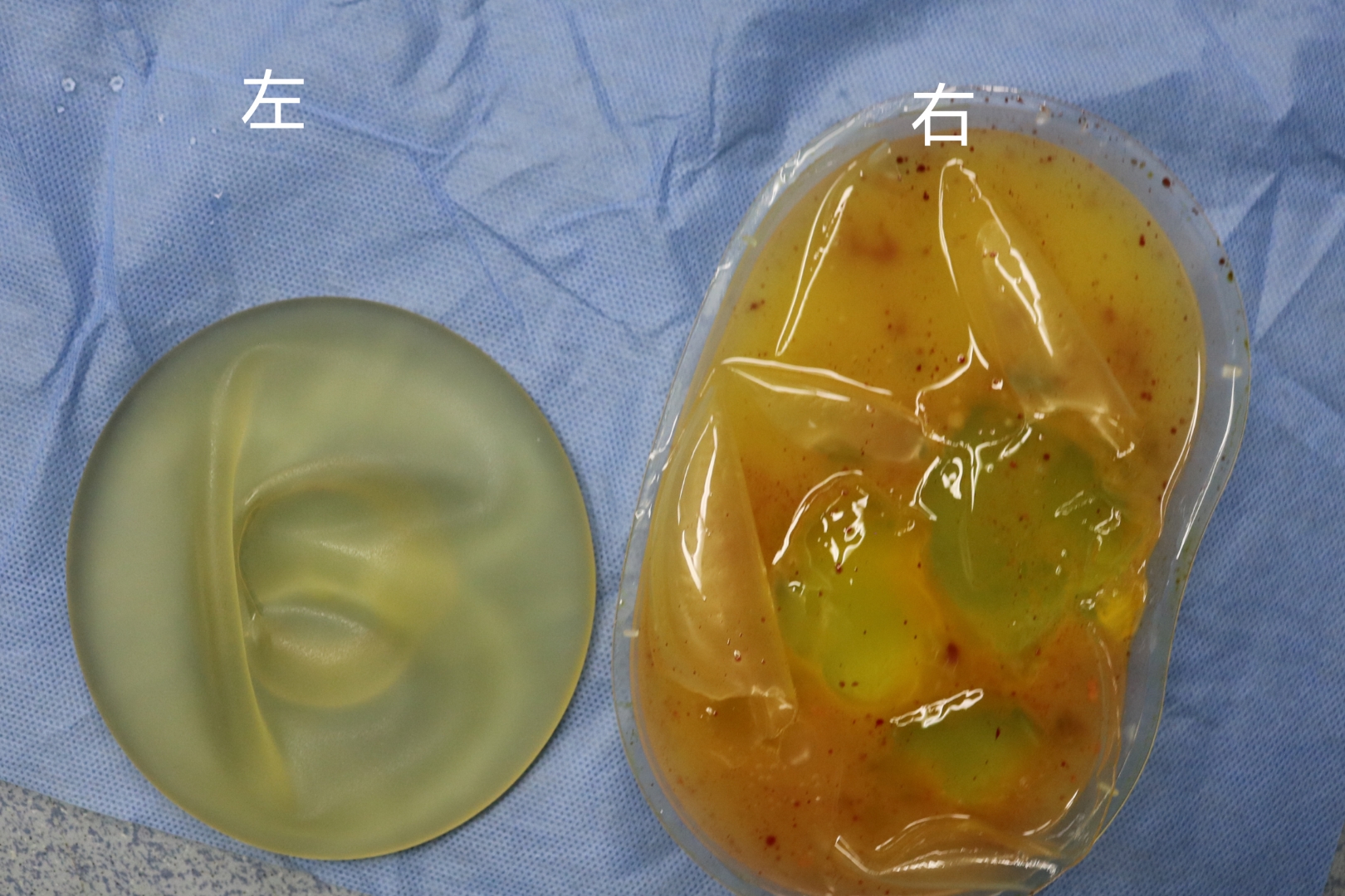 5kg 假体隆胸10年了,手感越来越硬,胸部也变形了 取出发现一侧已破裂!