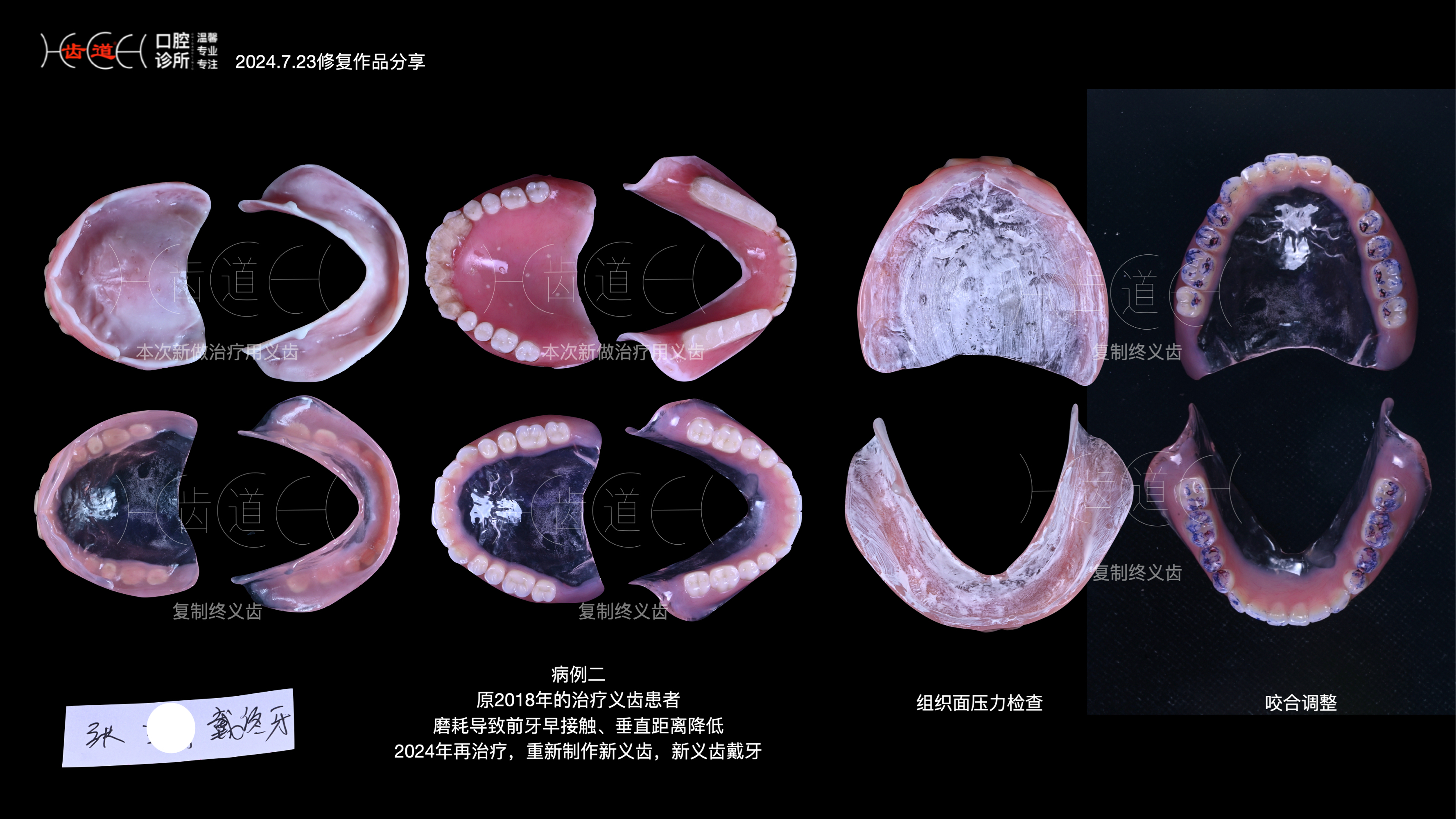 上牙6个假牙图片图片