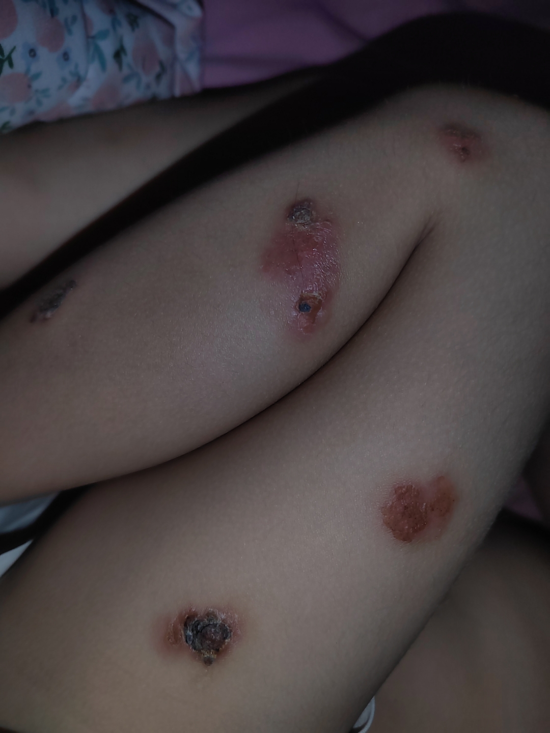 有啥好办法,当时被咬红了上面有小泡泡那种,现在成这样子了,孩子中途