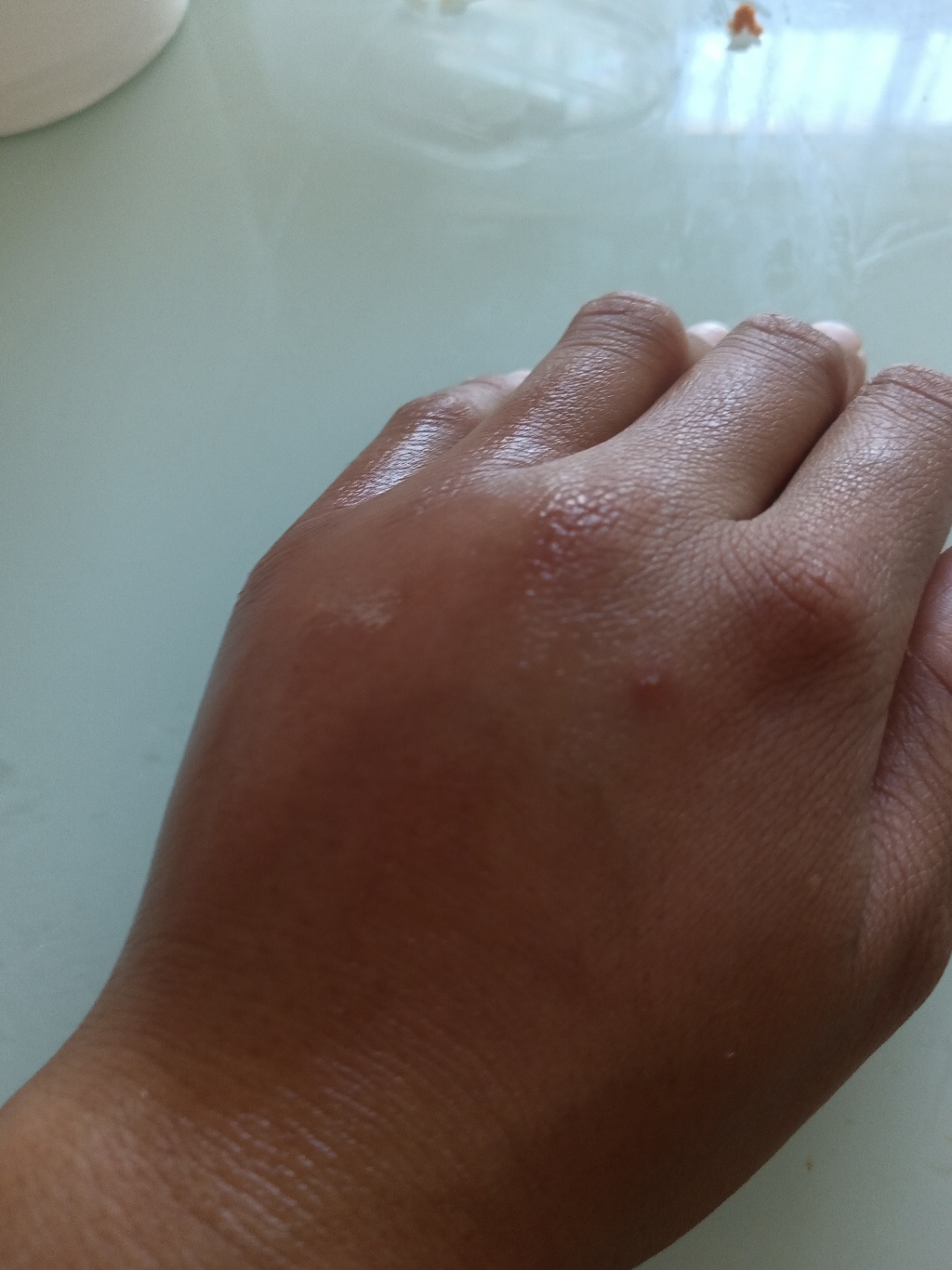 7月25日被黄蚂蚁咬到,当天全身长了红疹特别痒,洗了澡擦了红霉素软膏