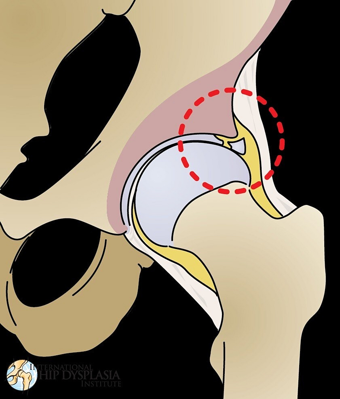 行医笔记10  一个髋臼盂唇损伤的病人  一个女病人,大概50岁左右.