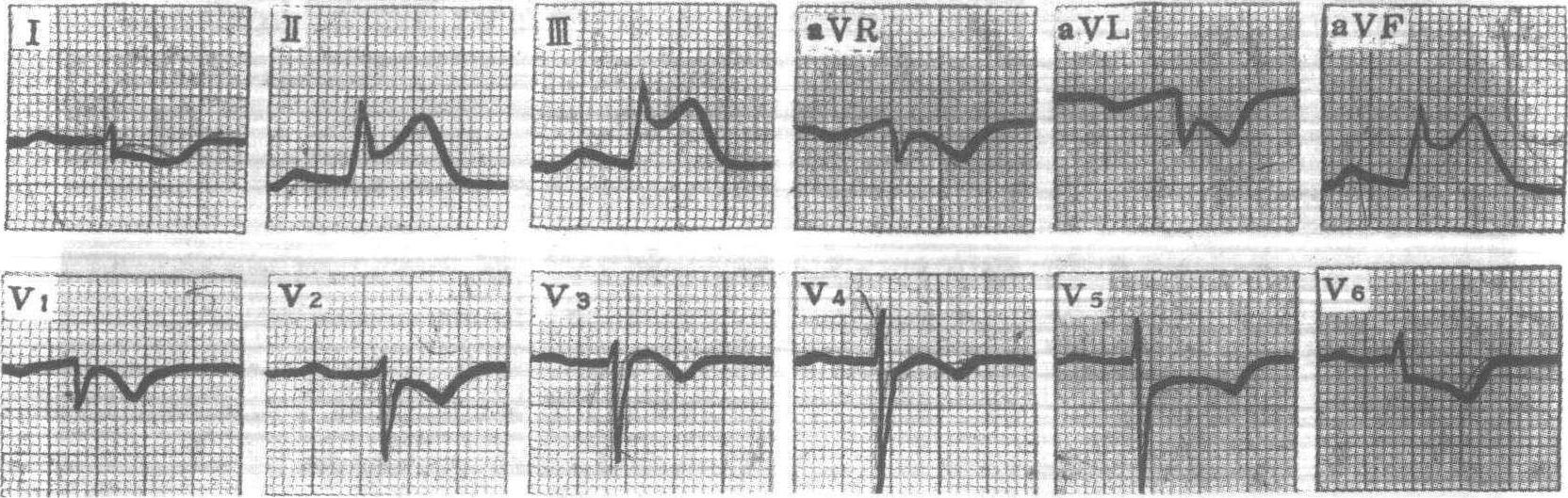 右室心梗心电图图片