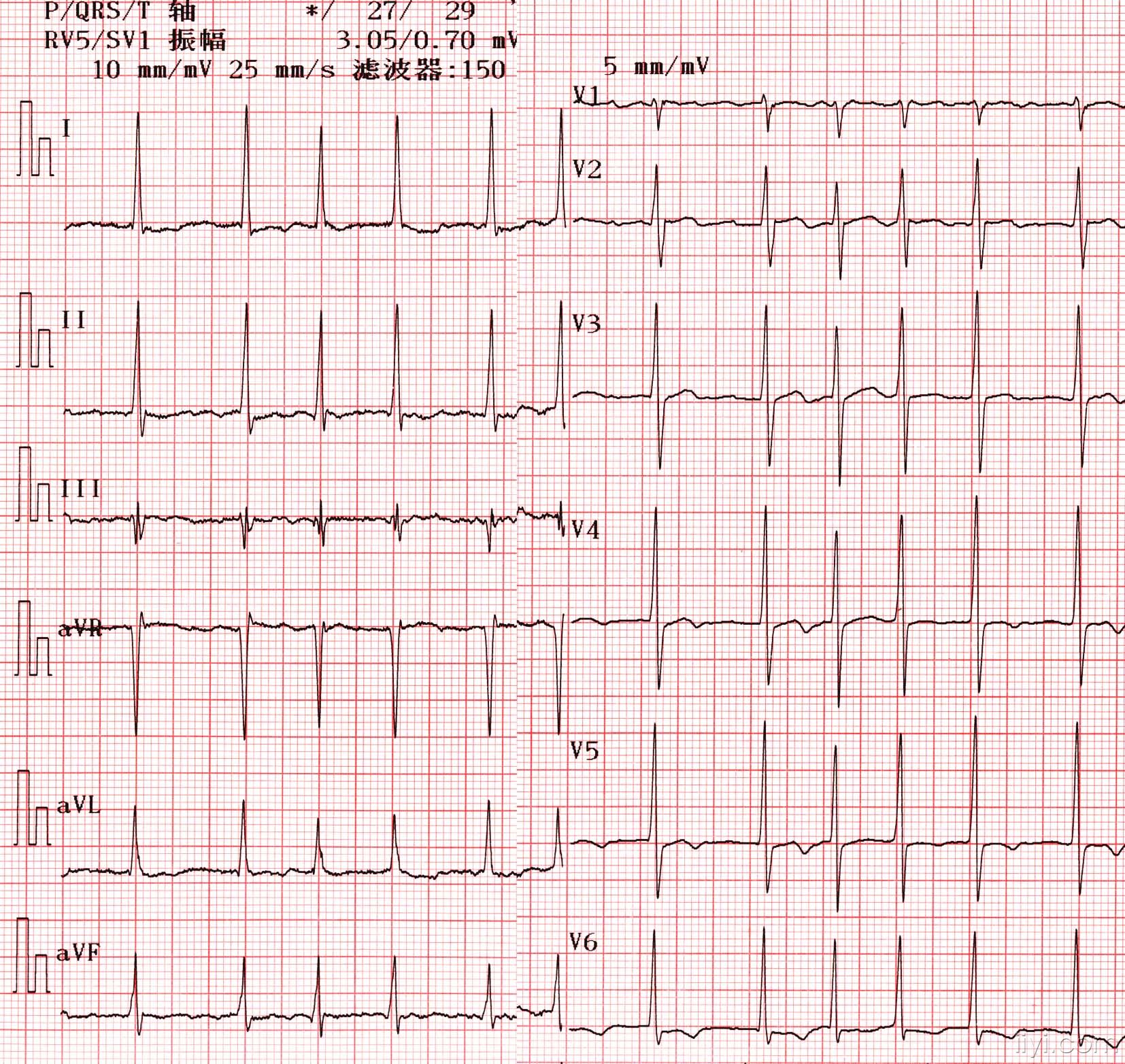 典型房颤心电图图片图片