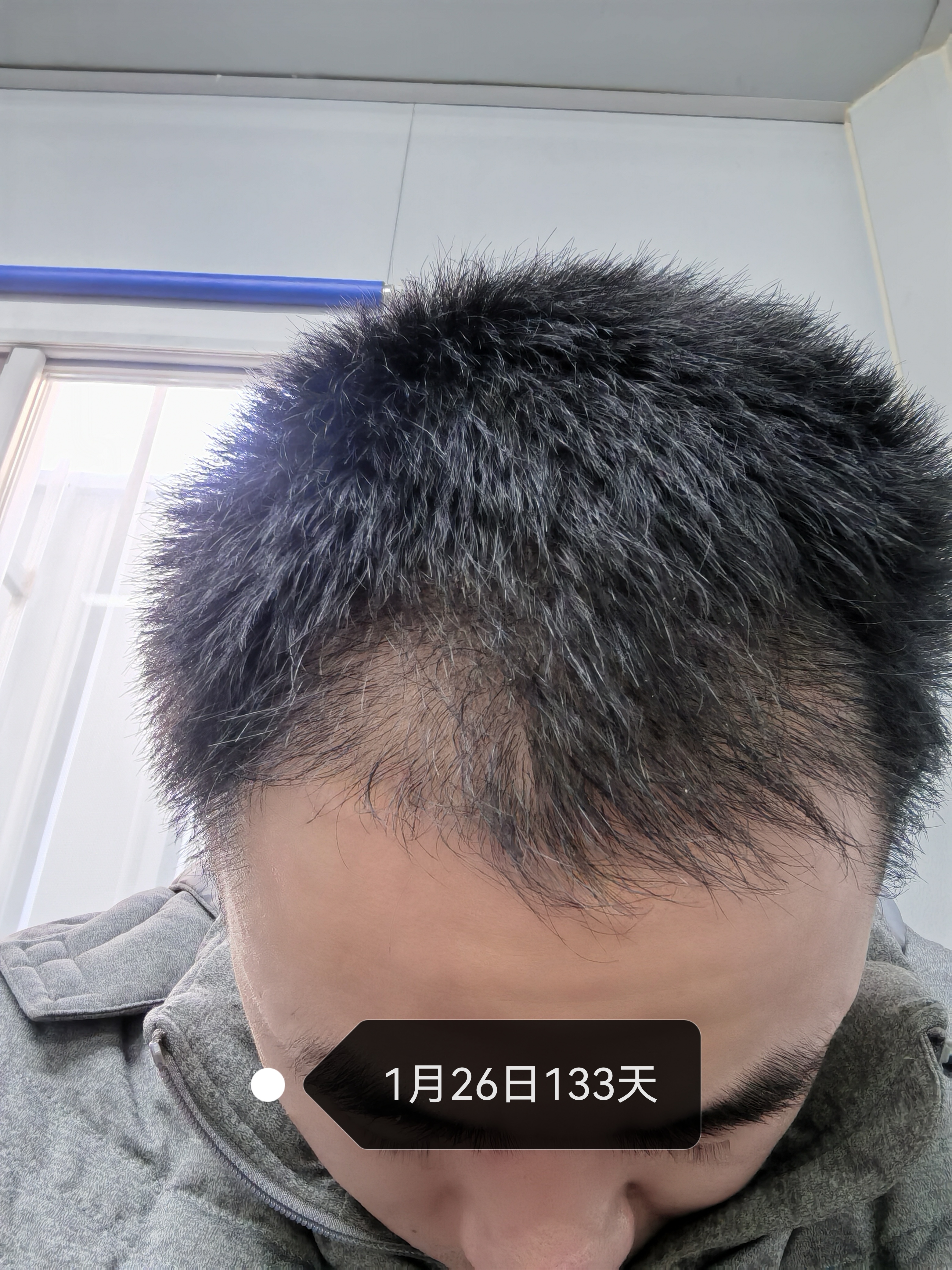 在这张照片中,男士的头顶呈现出一抹灰白色,稀疏的发丝显得格外引人