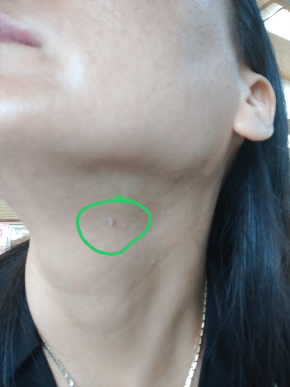 脖子上长了一个肉揪揪 长了一个多月了,用手揪不下来 最近这两感觉有