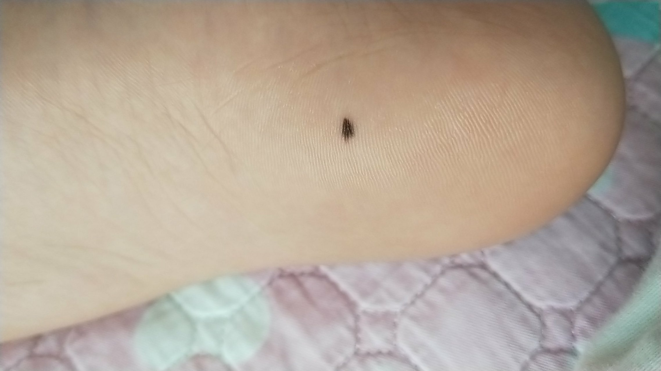 求帮忙!孩子脚底长这个黑点要紧吗?