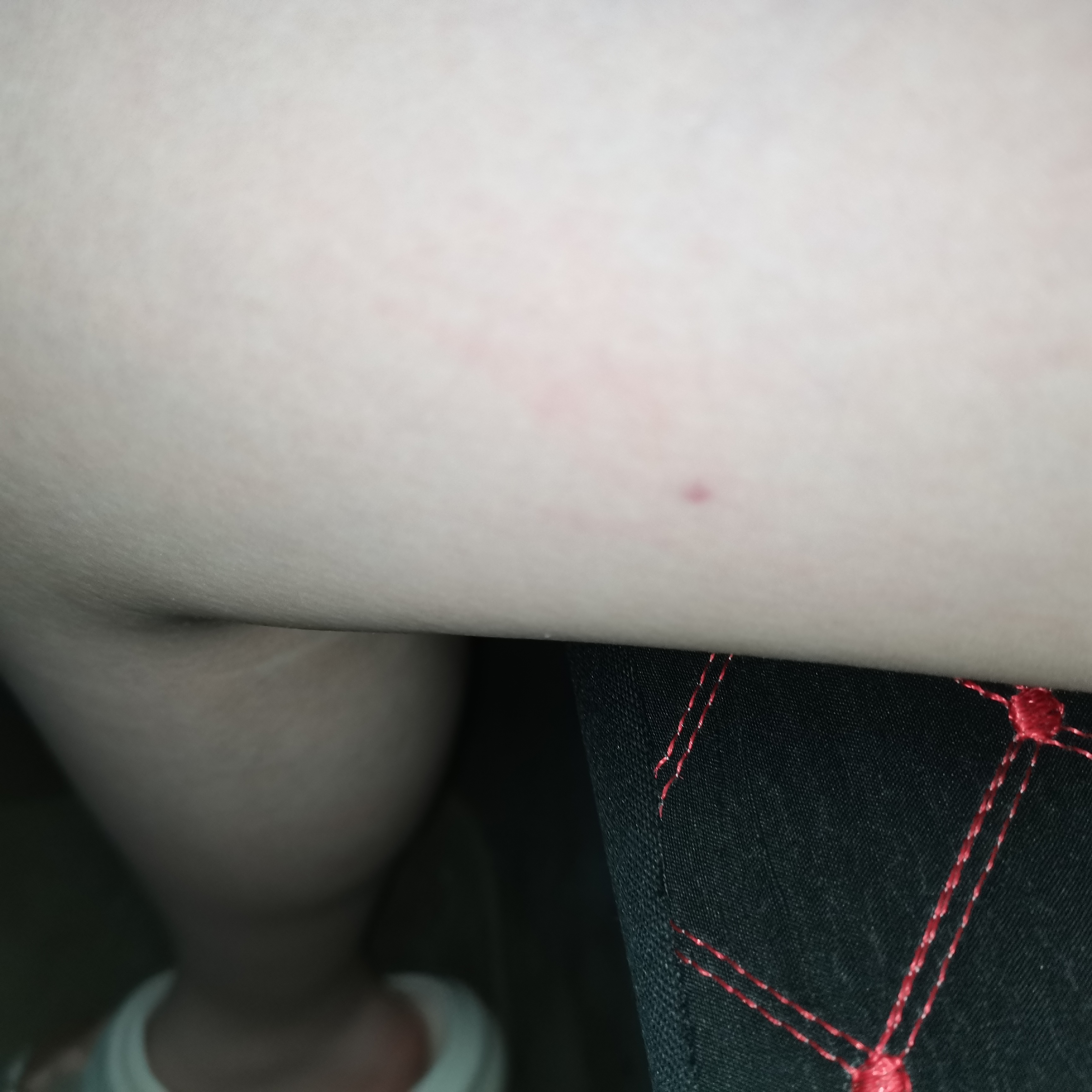 小红点怎么个事