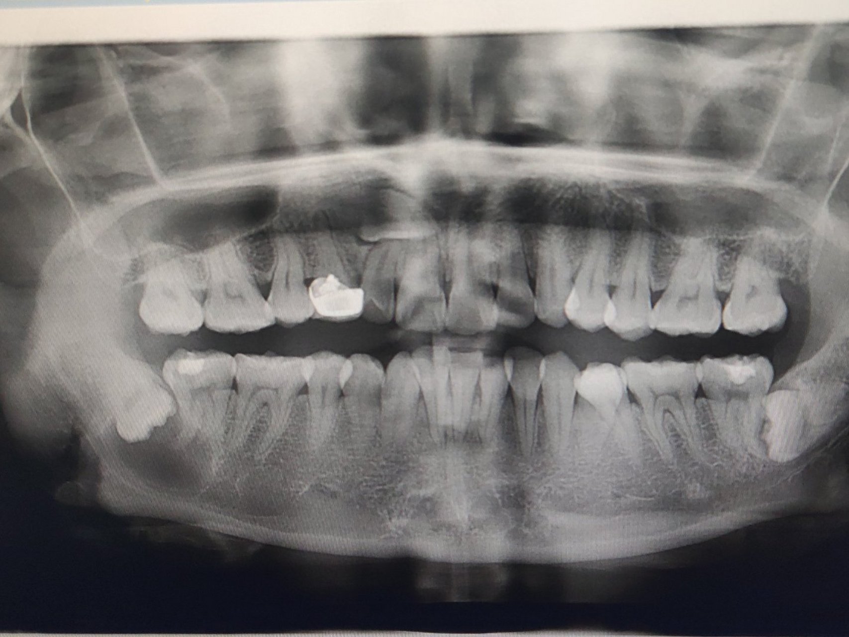 明天要去医院拔牙,智齿下面有囊肿,还有一颗埋伏牙,大夫说也许会伤到