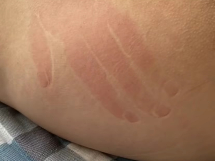 05第一眼看到这张背部皮肤照片,我就被那醒目的红色印记震撼到了!