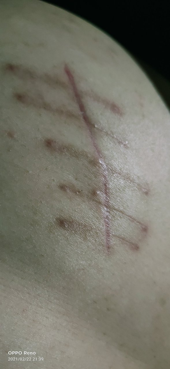 阑尾炎手术第二十天,接受伤疤