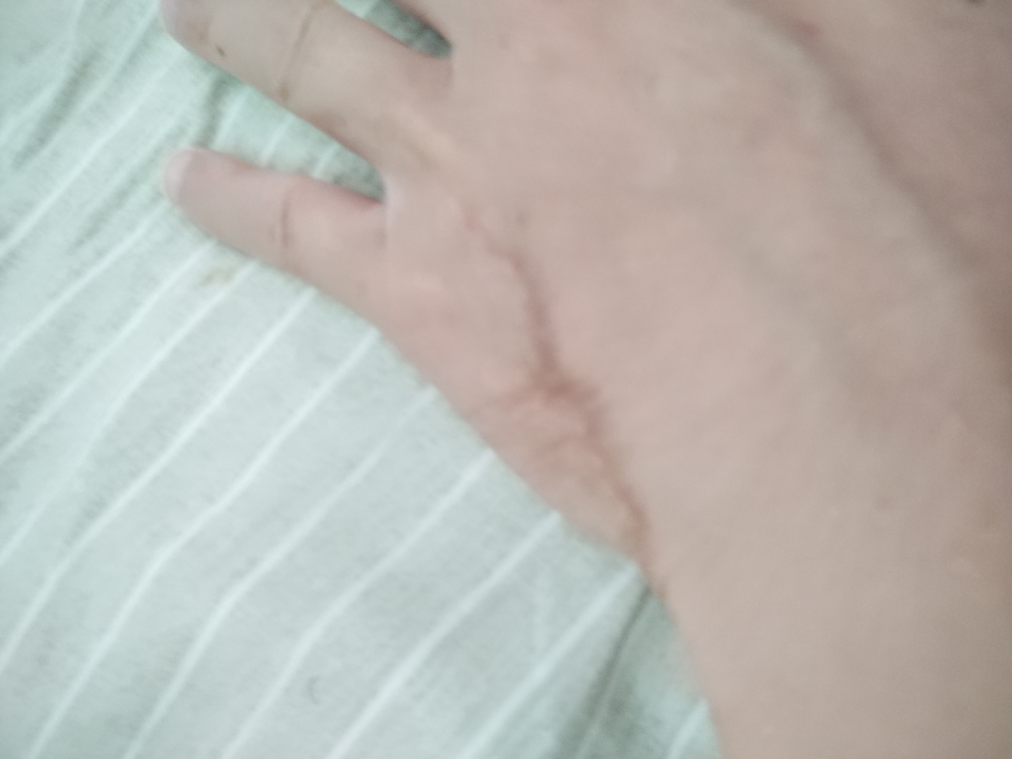 手上一条黑色血管