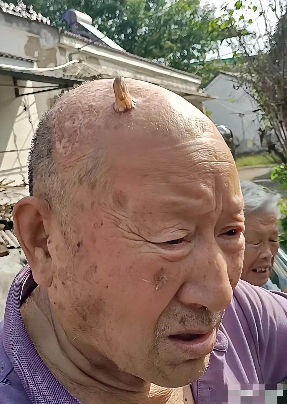安徽,有一名男子近日在网上发文,称他父亲头顶上这两年无端冒出一个