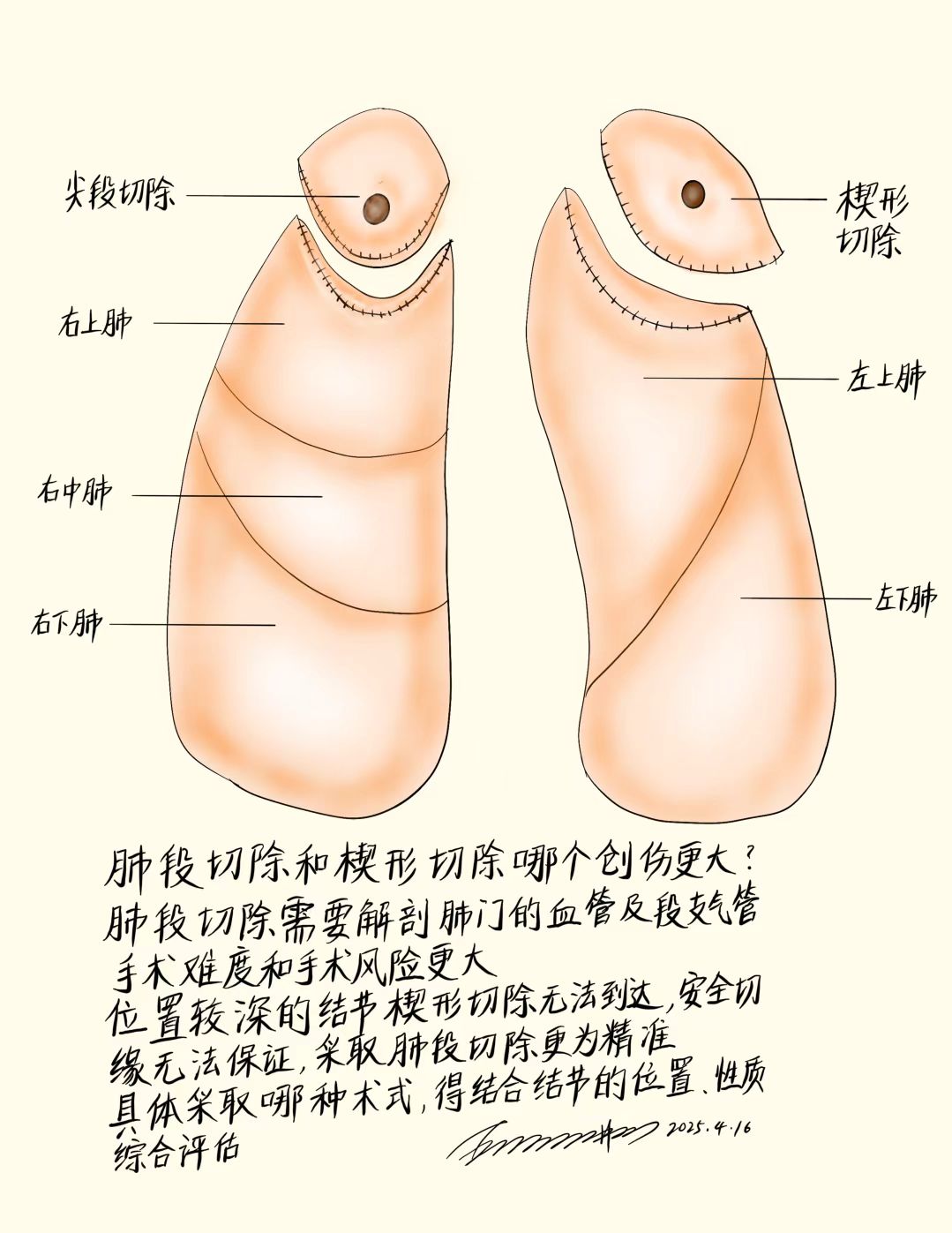 肺段切除和楔形切除哪个创伤更大?