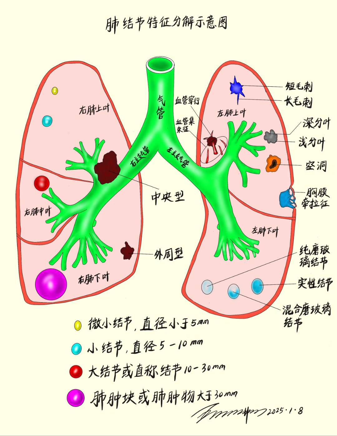 应好友呼吸科莫建明主任之邀,画个肺结节特征分解图,用于科普授课