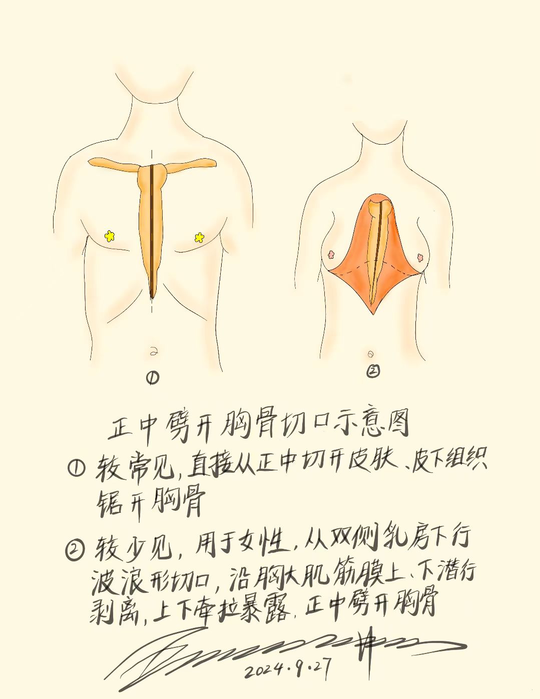 侧切在哪个位置图片图片