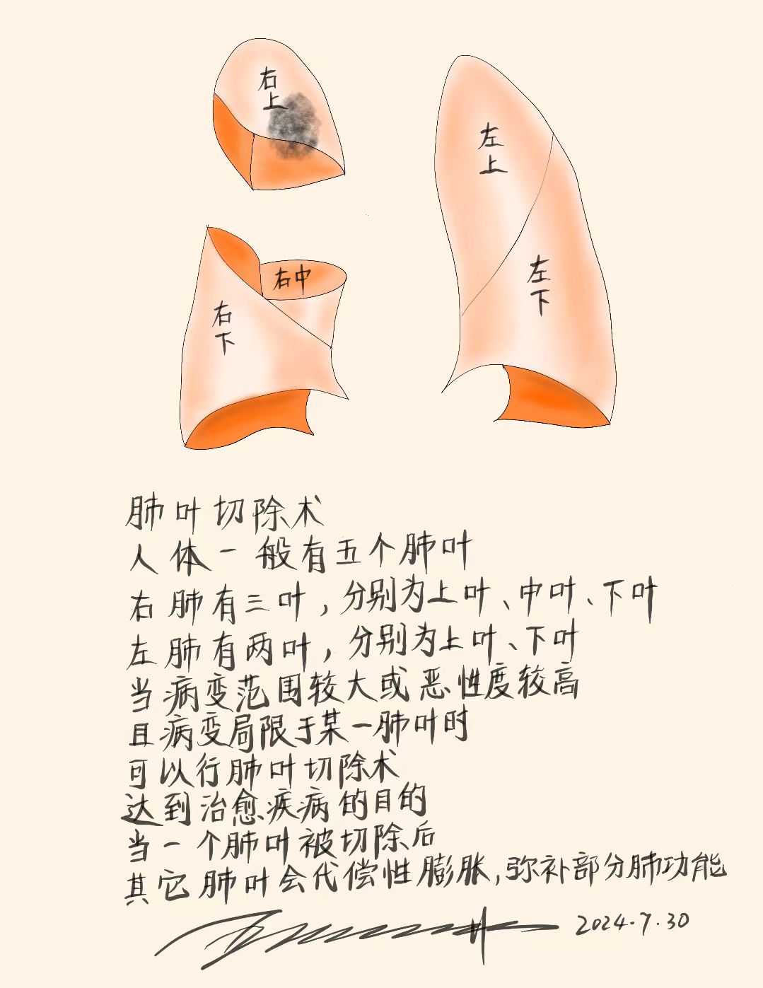 肺叶切除术 人体一般有五个肺叶 右肺有三叶,分别为上叶,中叶,下叶 左