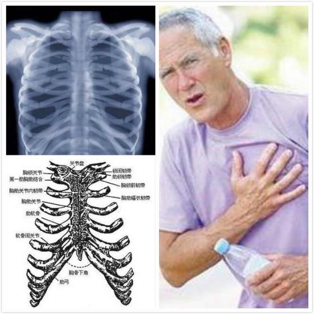 肋软骨炎的症状有哪些 肋软骨炎常见的病变好发部位为左侧第二肋软骨