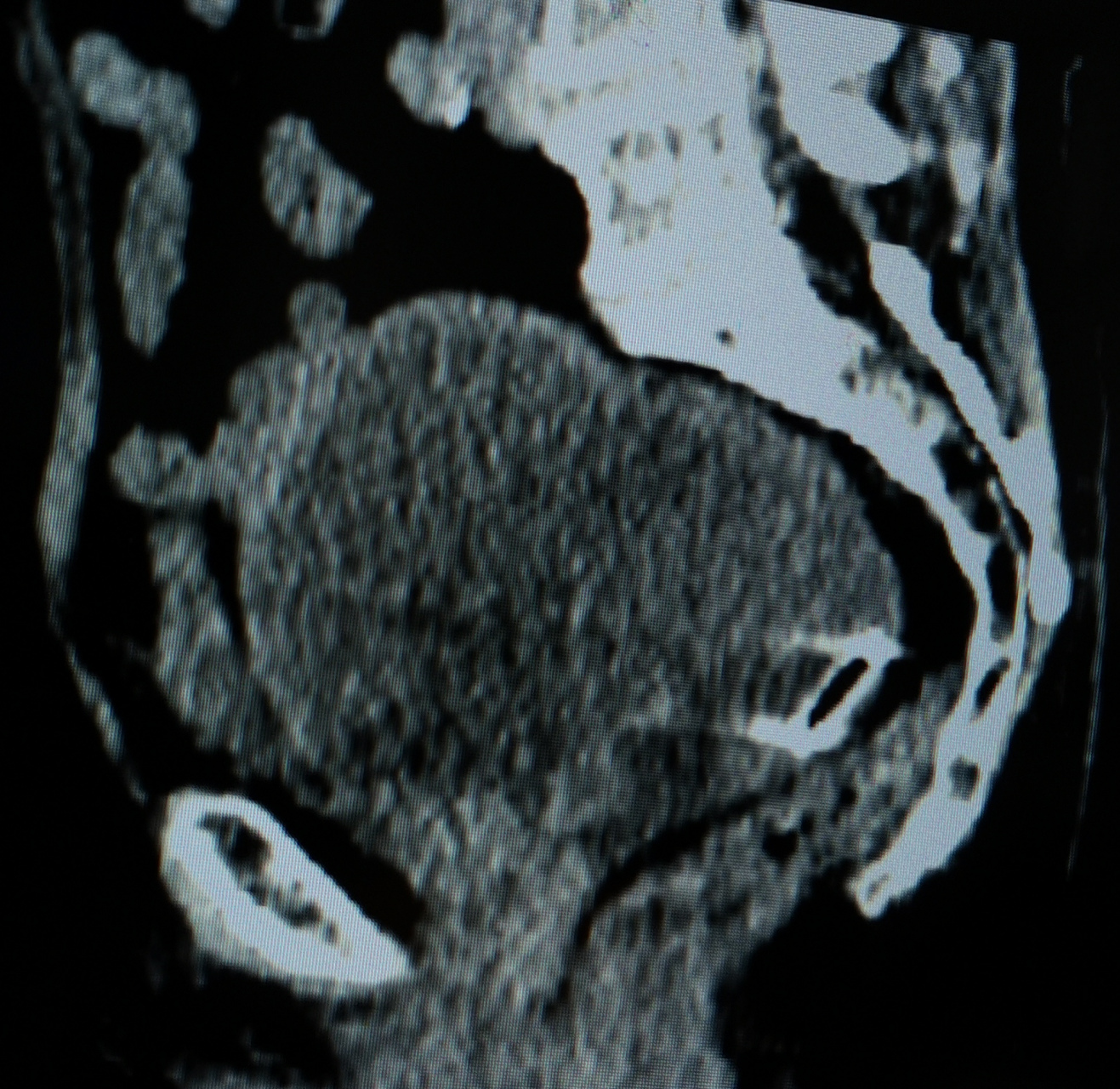 宫腔大量积液,积脓 老年女性,75岁,下腹痛做盆腔ct,子宫增大呈球形