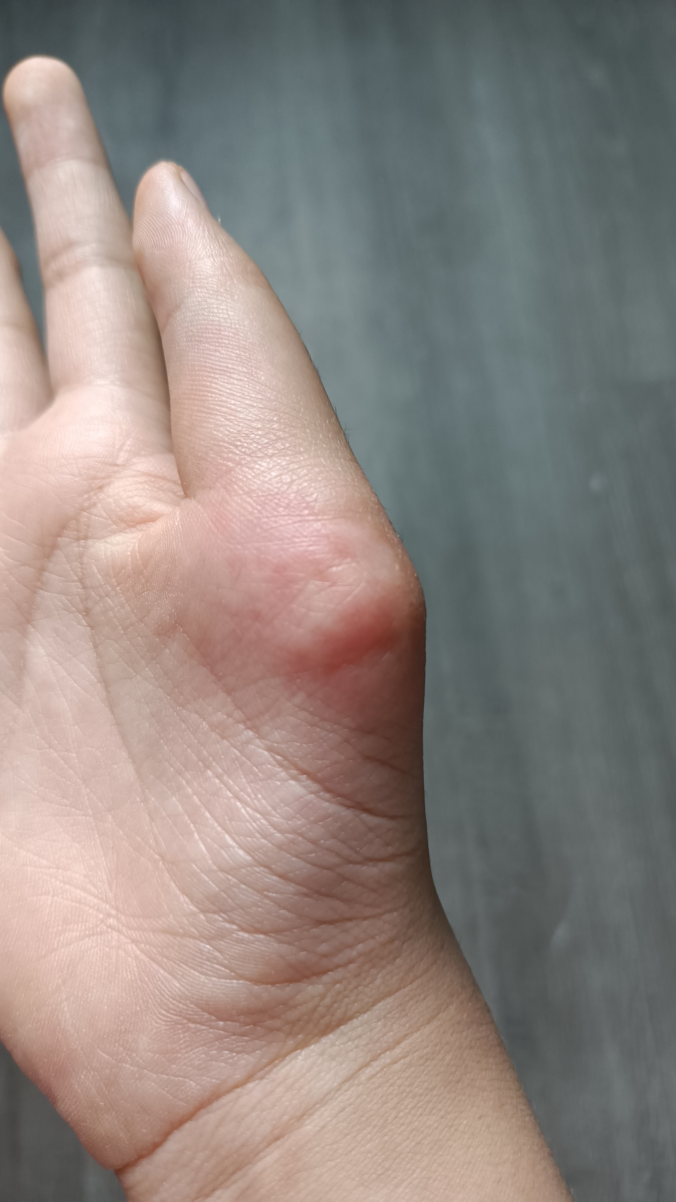 我刚生出右手就多长了一个大拇指(也就是6根手指头 刚生出6个月,我妈