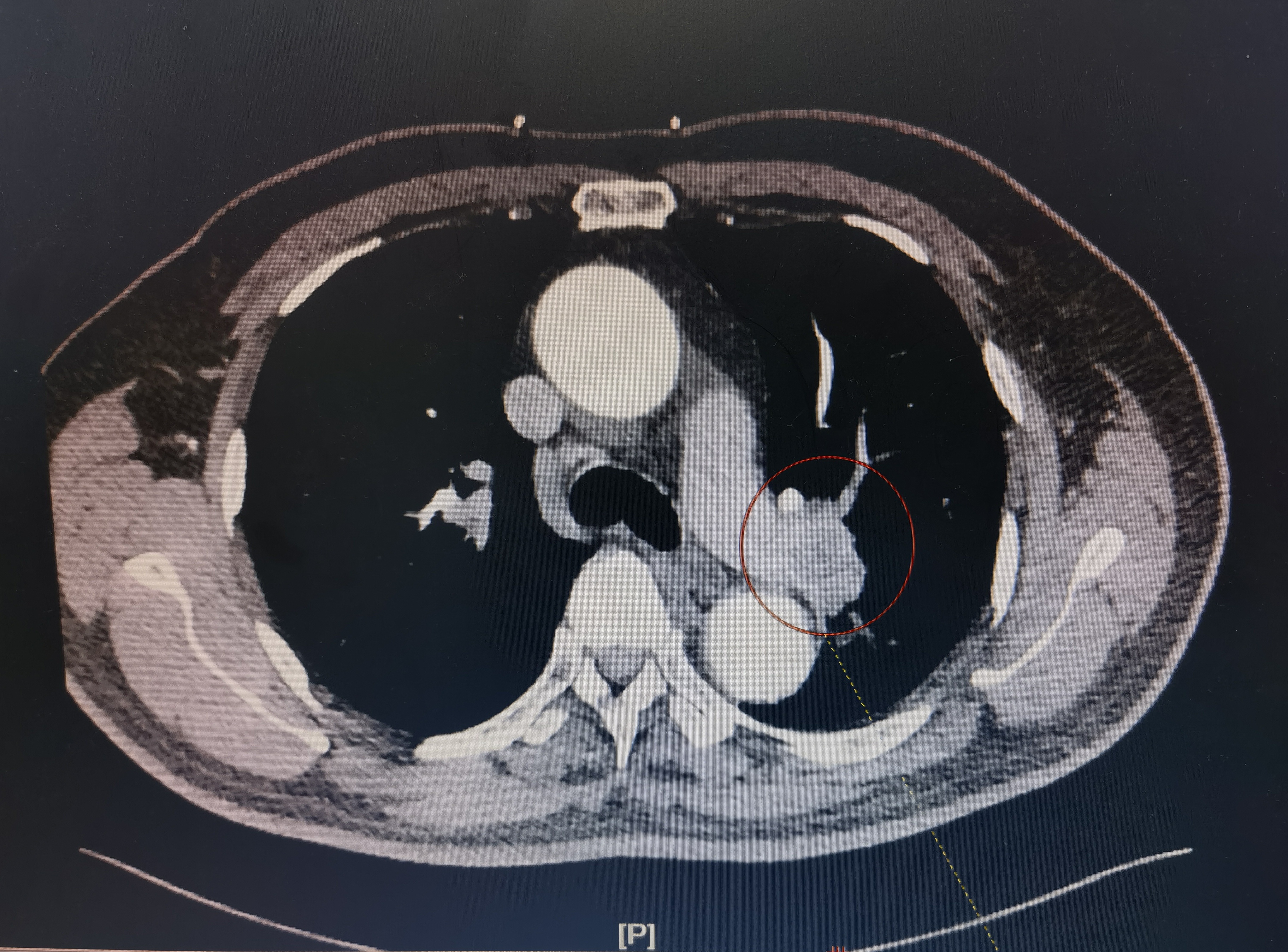 中心型肺鳞癌,新辅助治疗后,肿瘤明显缩小,通过单孔胸腔镜下微创治疗