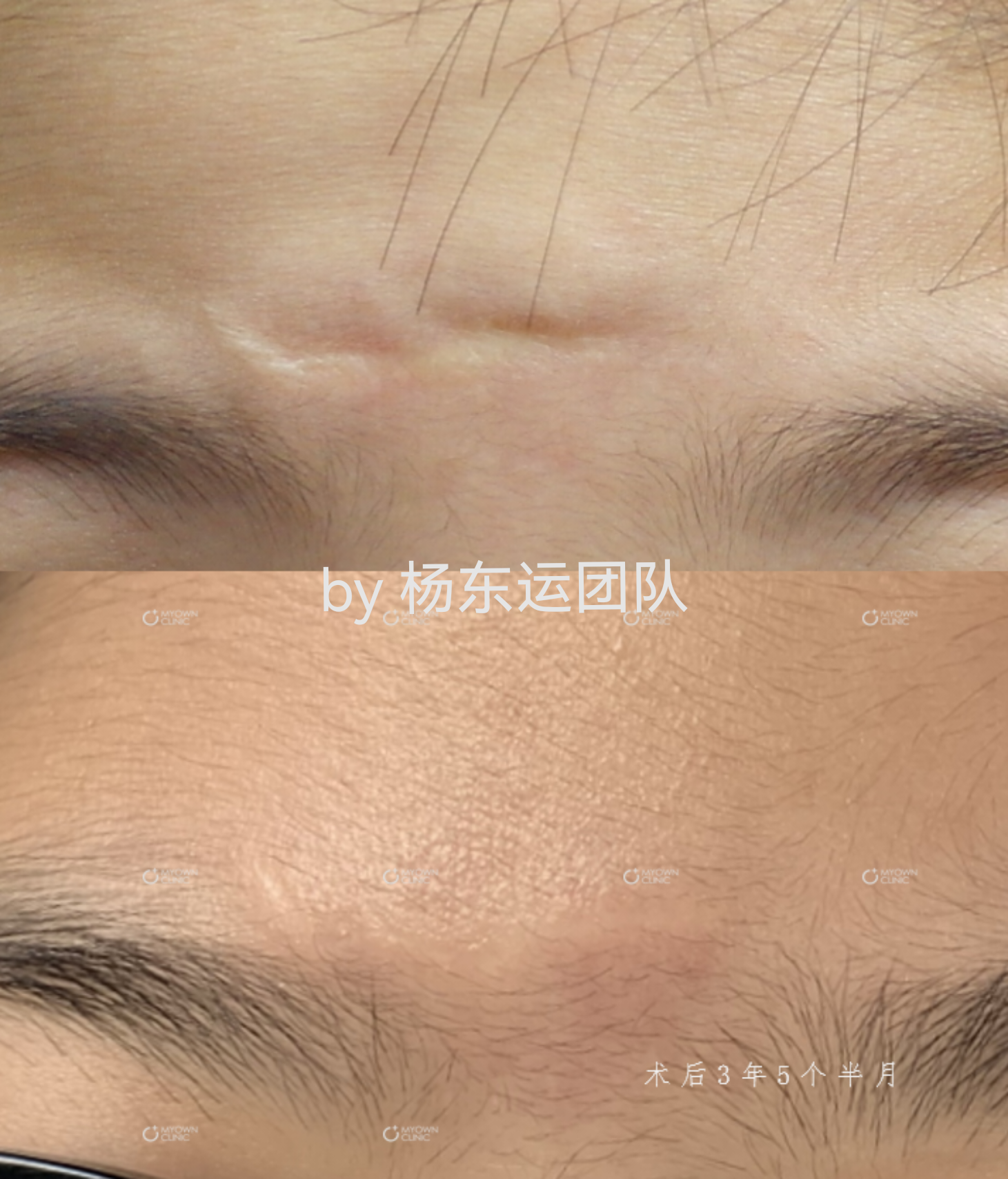 额部眉间的凹陷疤痕,手术修复后3年半.