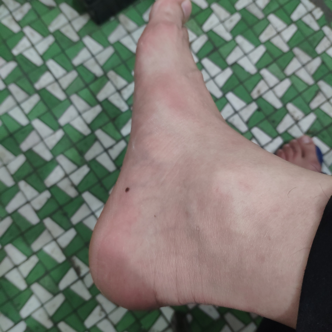 痣相解 男♂右脚上,这个位置有一颗"痣",究竟好?不好?