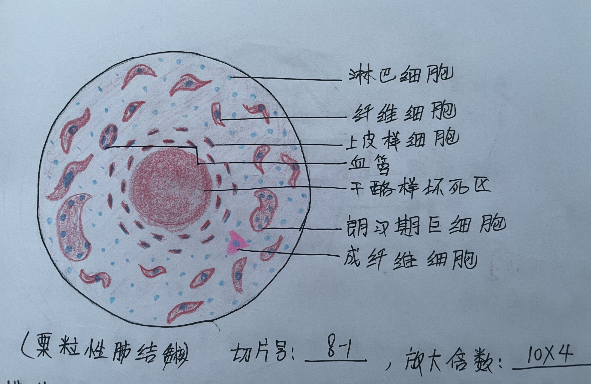 粟粒性肺结核红蓝铅笔手绘图