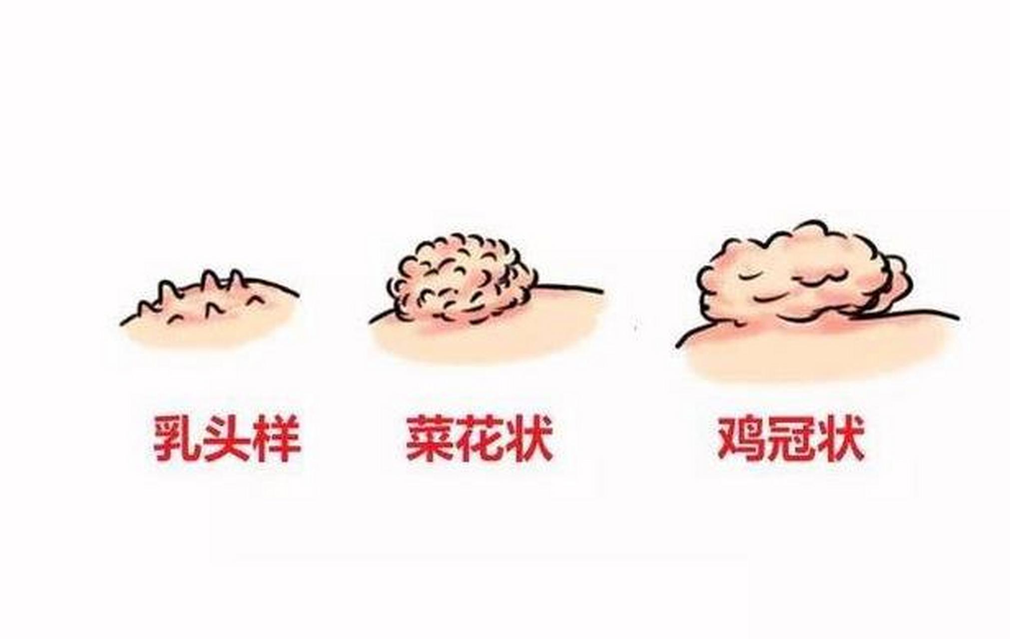#女性健康 女性尖锐湿疣的症状表现,尖锐湿疣是由人乳头瘤病毒(hp