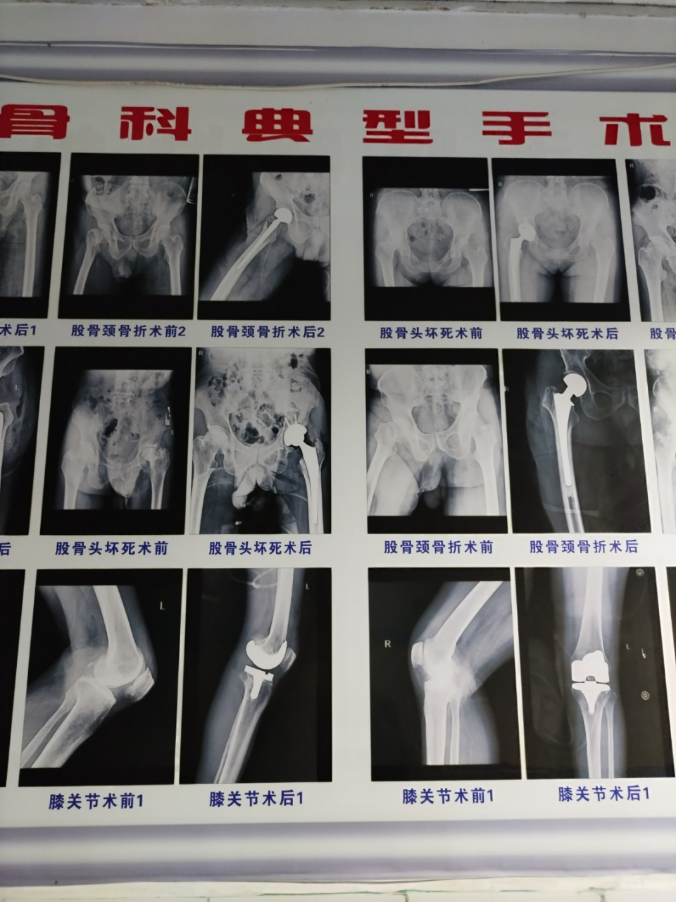 我坚决不想有我的骨科手术图片出现在墙上!