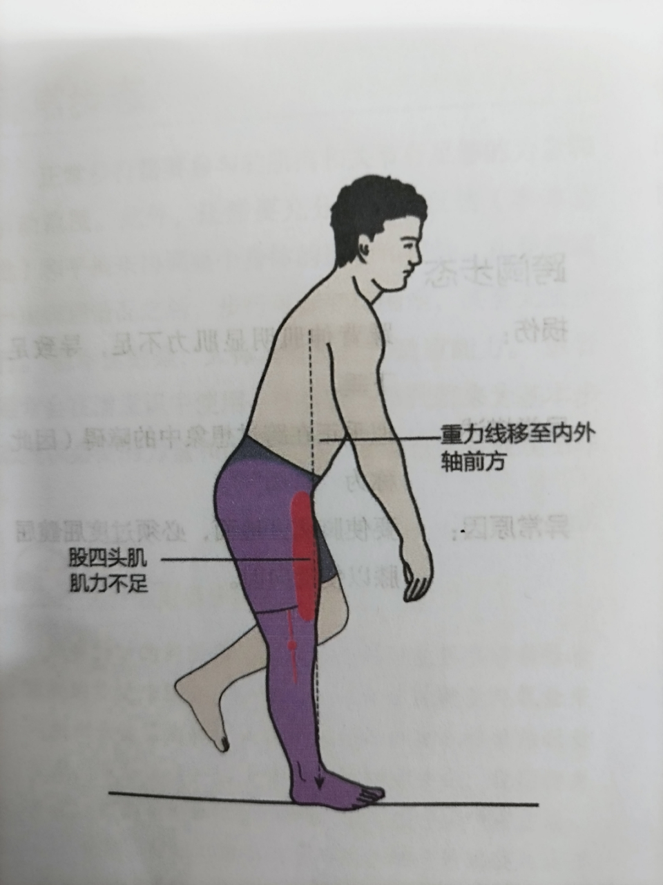 异常步态分享4——股四头肌步态: 损伤:	股四头肌肌力较弱或避免用力.