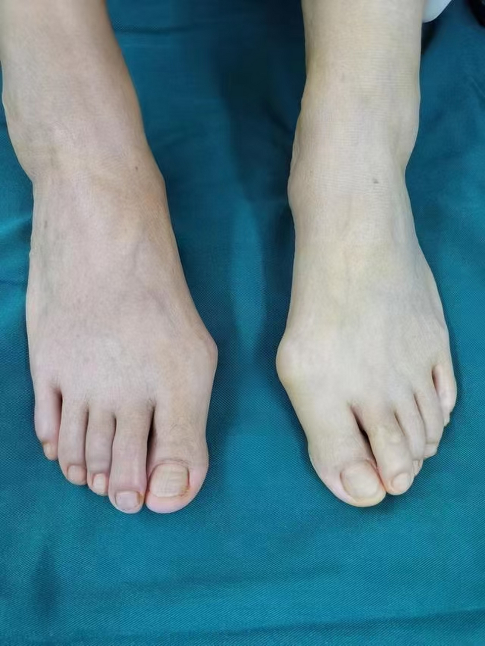 这种叫做拇指外翻,知道为啥会出现拇外翻不,又跟哪些肌肉有关呢,拇