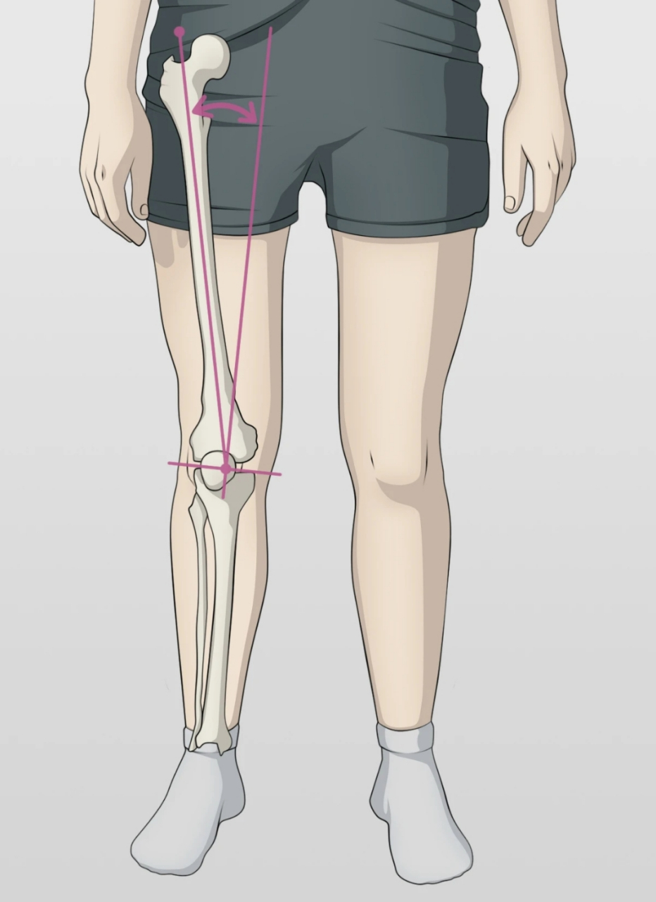 膝关节外翻测量图示图片