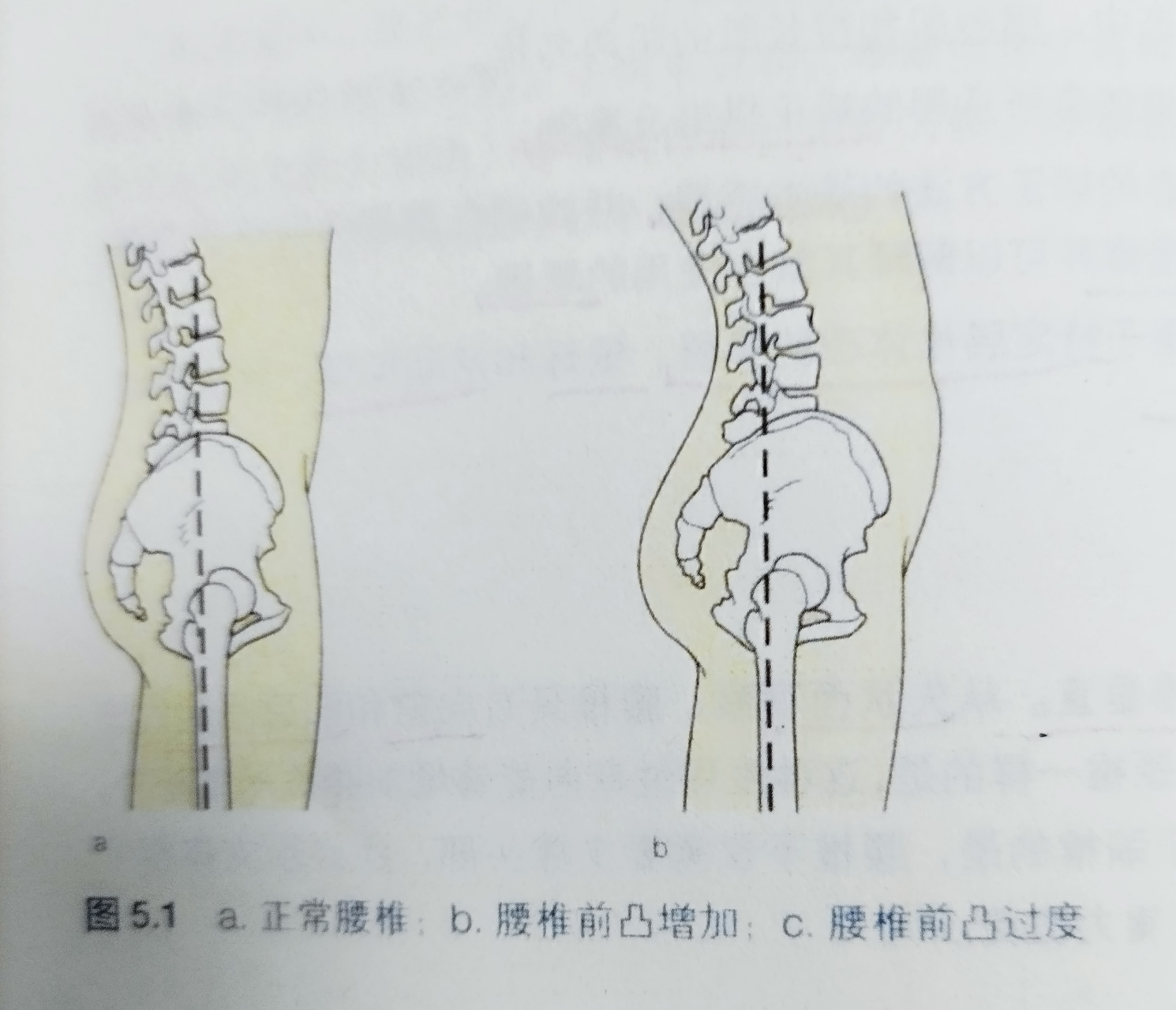 腰椎前凸症状图片