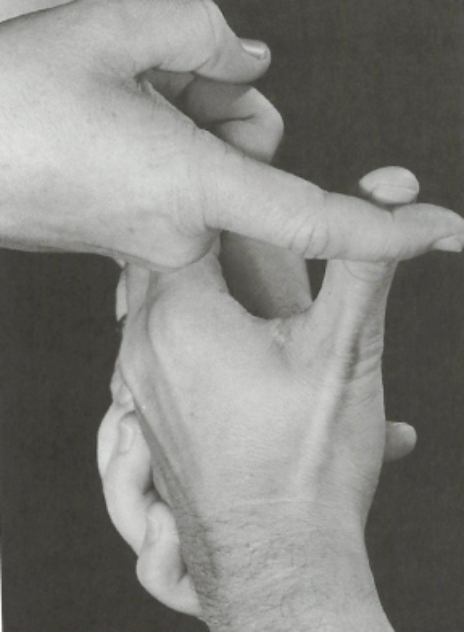 —拇长伸肌: 起点:尺骨远端后表面的中1/3及骨间膜;止