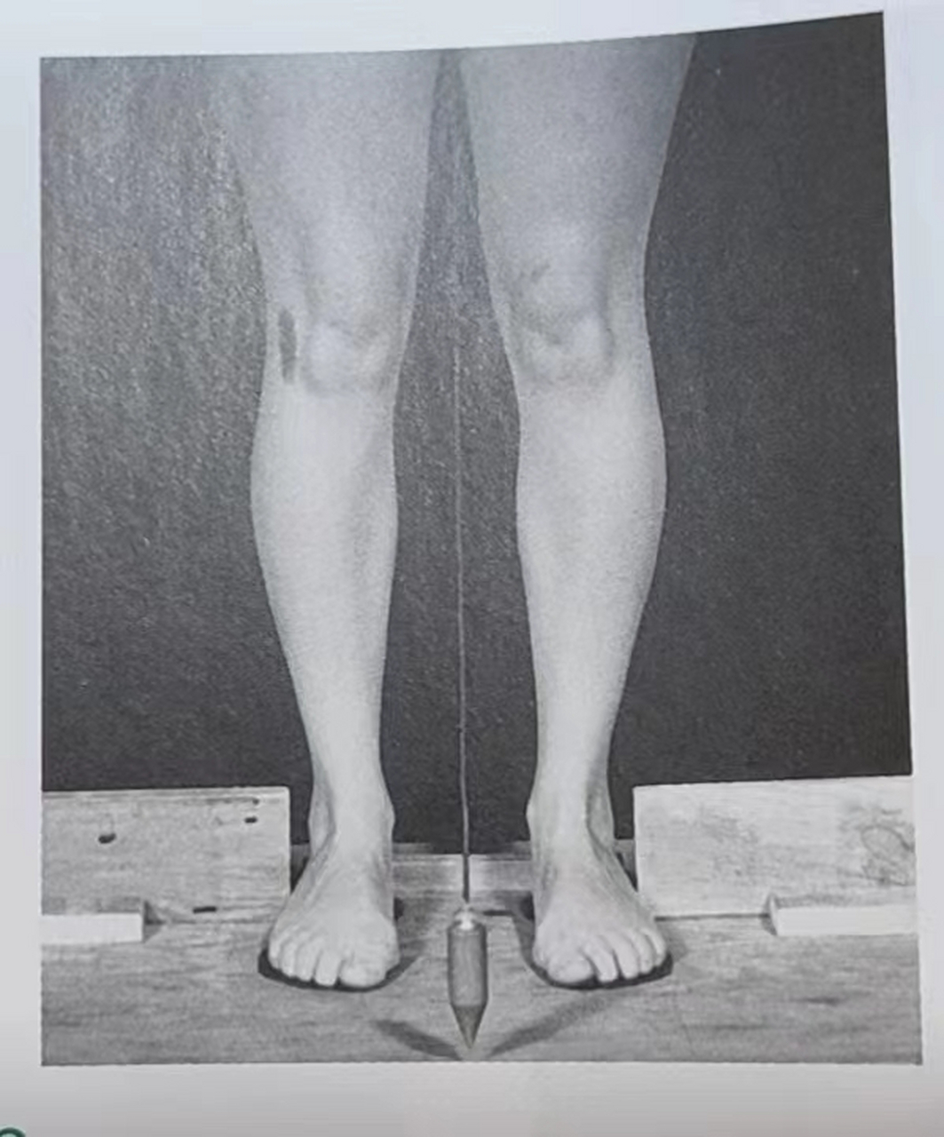 下肢力线:正面的第二张图 大家跟我一起来看一下,观察一下这个大腿根