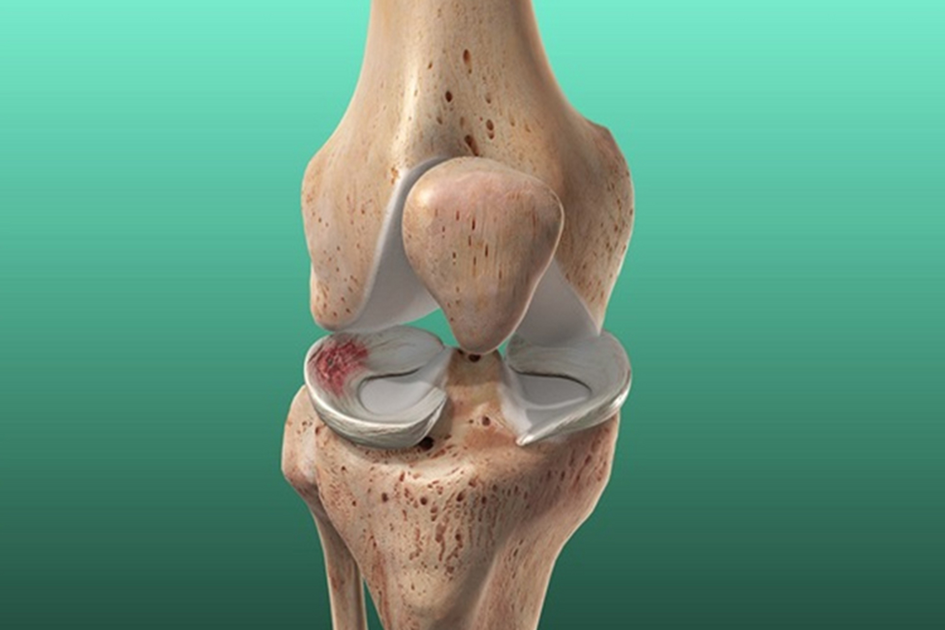 膝关节疼痛2——内侧半月板的损伤: 内侧的半月板附着在我们的韧带和